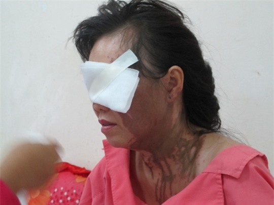 Bàng hoàng phụ nữ bị tạt axit giữa trung tâm TP. HCM