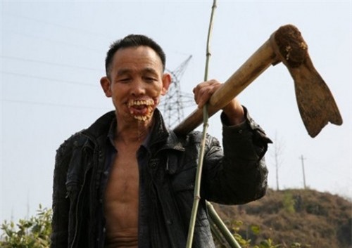 Kinh hoàng hàm răng mọc trên mặt vì bị chó sói cắn