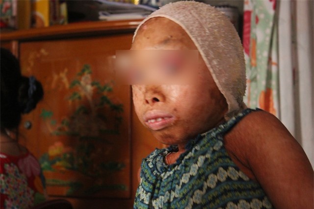 Xót xa cảnh gia đình có hai con mắc bệnh lạ