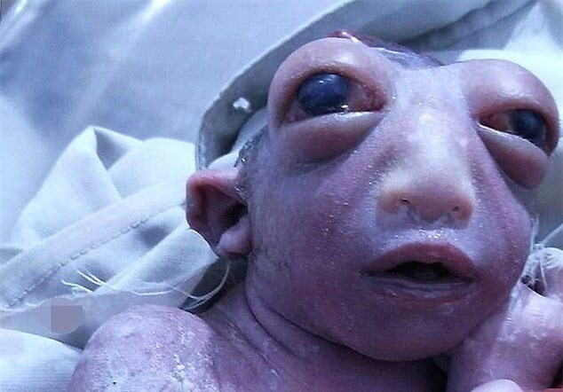 Ấn Độ: Bé sơ sinh chỉ có nửa đầu và mắt to