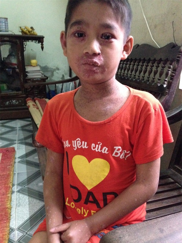 Nhói lòng cậu bé 14 tuổi sống đơn côi bị lở loét khắp người
