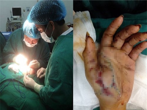 Bé trai 12 tuổi nát tay, nổ nhãn cầu vì đốt pháo diêm tự chế