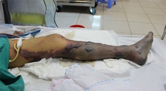 Bàng hoàng 4 người nguy kịch vì ăn tiết canh lợn