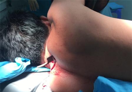 Bị kẻ ngáo đá đâm thủng phổi, kéo vẫn dính chặt ở lưng lúc nhập viện
