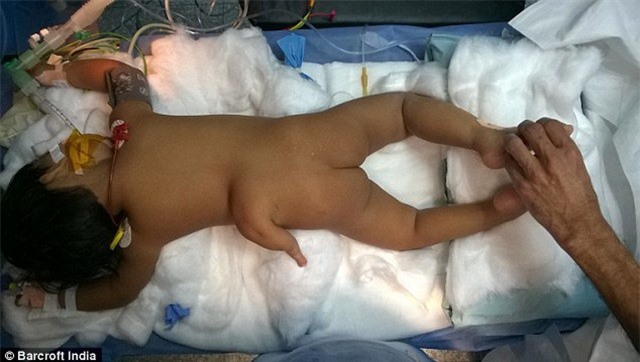 Sốc: Cô bé Ấn Độ mắc chứng bệnh hiếm gặp nhất thế giới