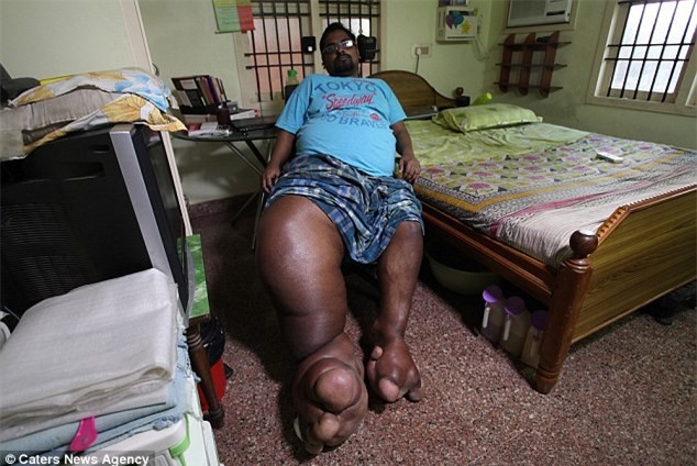 Kỳ lạ: Chàng trai có bàn chân to như... voi