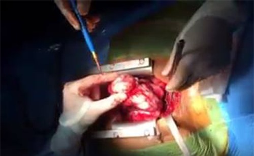 Phát hiện khối u khổng lồ gần 1kg trong ngực nam sinh viên