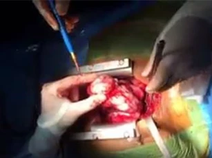 Phát hiện khối u khổng lồ gần 1kg trong ngực nam sinh viên