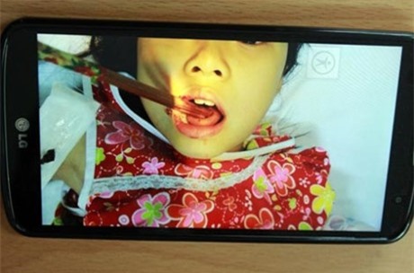 Ăn ở sân chơi, bé gái bị bóng văng vào làm đũa đâm xuyên lưỡi