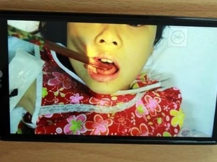 Ăn ở sân chơi, bé gái bị bóng văng vào làm đũa đâm xuyên lưỡi