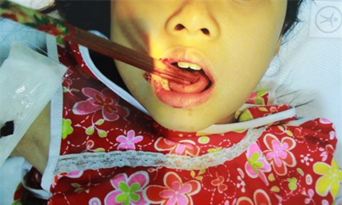 Sốc: Bé gái bị đôi đũa cắm xuyên lưỡi khi đang ăn cơm