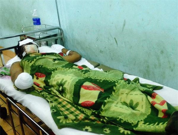 Cuốc phải mìn, bị nổ cụt tay và hỏng mắt