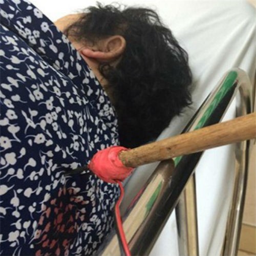 Cụ bà bị tên cướp bắn mũi tên ghim vào lưng, cướp túi xách