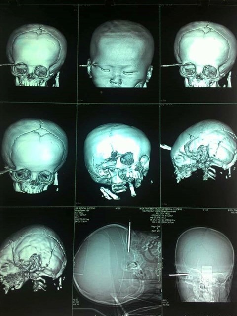 Nghịch dại, bé trai 14 tháng tuổi bị tuốc nơ vít đâm xuyên thái dương
