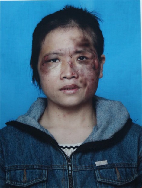 Sốc: Chồng cầm bát inox nóng đỏ áp thẳng vào mặt vợ