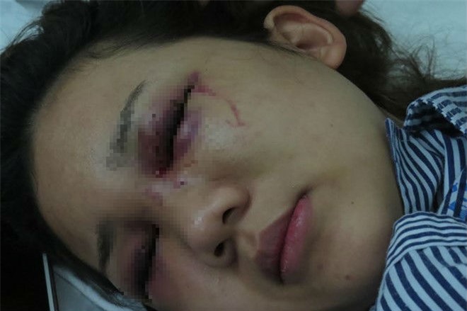 Thiếu uý công an bị đố đánh bạn gái "tím mắt, dập đầu"