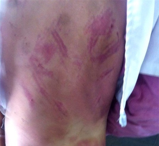 Đánh mất 1.000 đồng, bé 8 tuổi bị mẹ kế đánh đập dã man