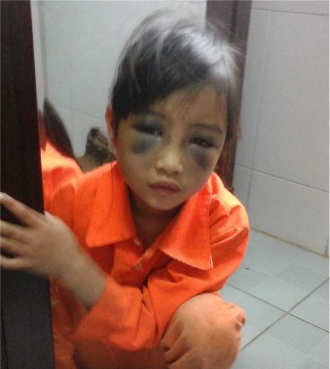 Viết chính tả chậm, bé gái bị đánh bầm dập mặt mũi