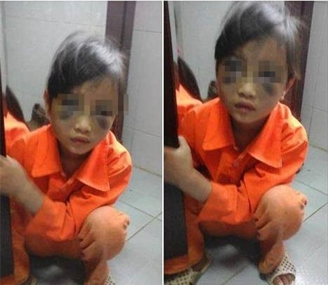 Cô giáo đánh bầm dập mặt bé gái: Công an triệu tập điều tra