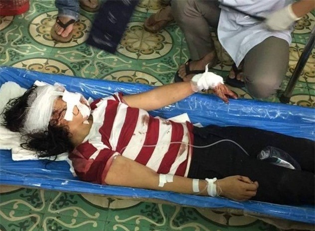 Xét xử gã chồng tàn bạo cắt gân tay, gân chân vợ 