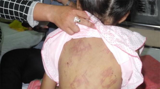 Người mẹ kế đánh con chồng bầm tím cơ thể bị khởi tố