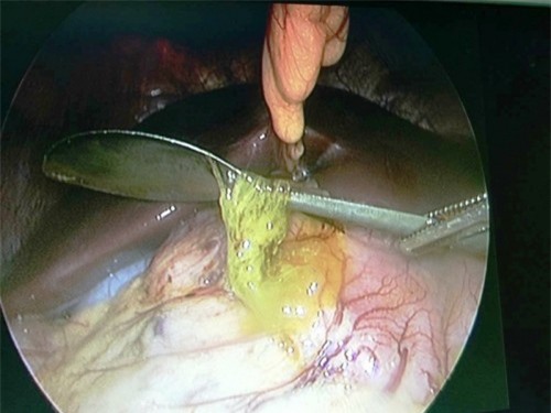 Cứu sống thành công thiếu nữ uống nước chanh, nuốt luôn cả...thìa