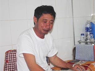 Người đàn ông lở loét vòm họng, nổi nốt sau khi ăn cá