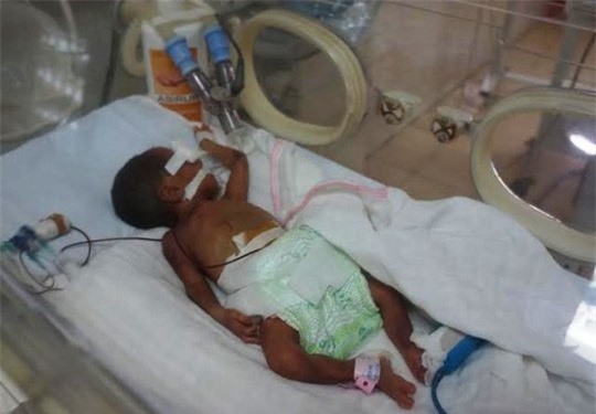 Bé gái sơ sinh suýt bị chôn sống đang nguy kịch