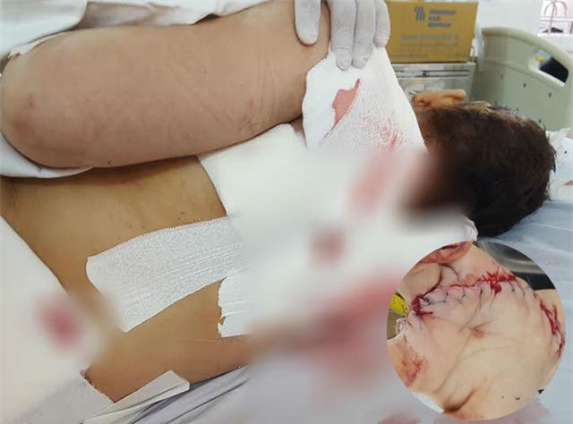 Chồng ác man chém vợ liên tiếp vì nghi ngờ bị “cắm sừng”