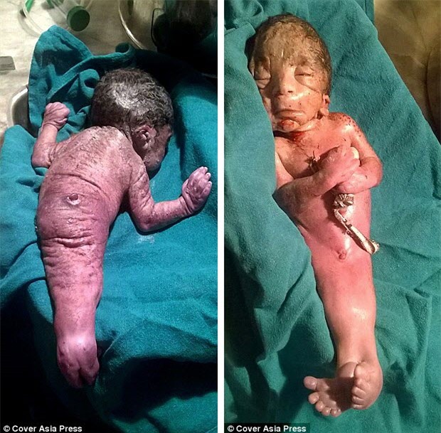 Sốc: "Người cá" vừa được sinh ra tại Ấn Độ