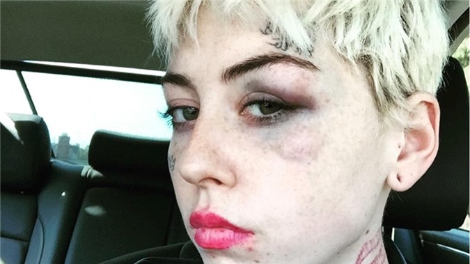 Sốc: "fan cuồng" Donald Trump đánh tím mặt nghệ sĩ Mỹ