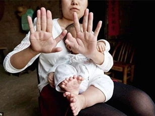 Trung Quốc: Độc đáo bé trai có 31 ngón chân và tay