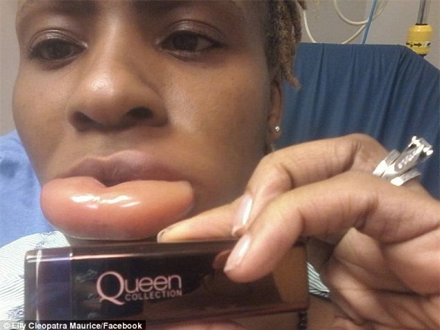 Dị ứng son, khuân mặt một phụ nữ "biến dạng"