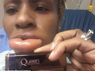 Dị ứng son, khuân mặt một phụ nữ "biến dạng"