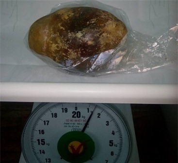 Cần Thơ: Phẫu thuật lấy viên sỏi bàng quang nặng 1,5 kg 