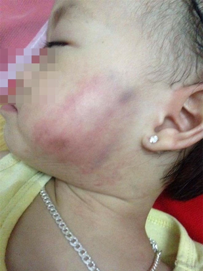 Công an điều tra vụ cháu bé bị cô giáo mầm non tát thâm tím mặt