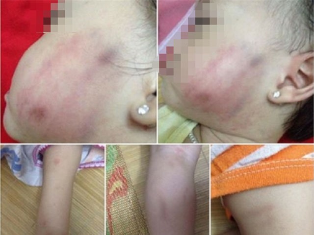 Hiệu trưởng mầm non thừa nhận cô giáo đánh trẻ bầm tím người