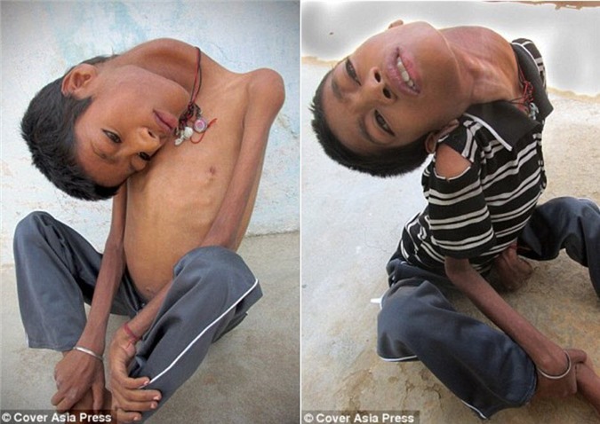 Ấn Độ: Sốc với cậu bé có thể gập ngược đầu