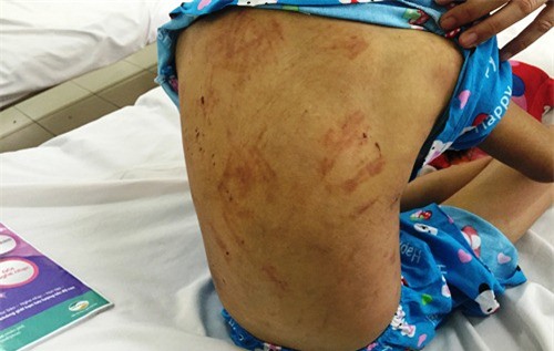 Mẹ kế đánh con chồng bầm dập... vì 1.000 đồng