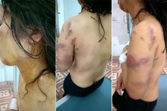 Nghi vấn chồng đánh vợ bầm dập cơ thể chấn động dư luận