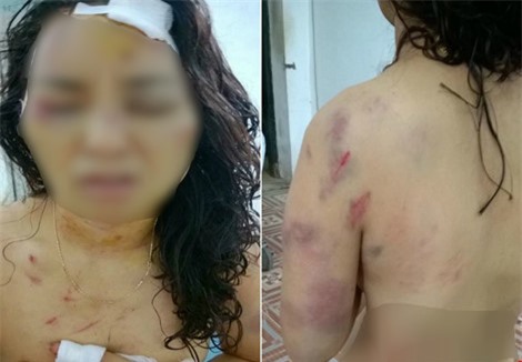 Chồng cầm dao đánh vợ phải khâu gần 20 mũi khi bị làm nhục