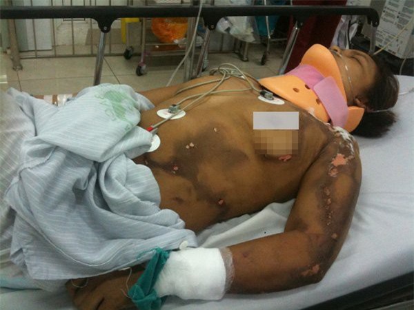 Đang cấy ngoài đồng, người phụ nữ bị sét đánh bất tỉnh