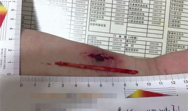 Bất ngờ phát hiện đũa dài hơn 8cm găm trong bắp tay suốt cả tháng