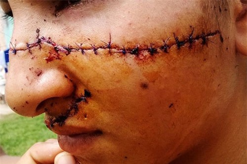 Hôn gái lạ giữa phố, thanh niên bị người yêu rạch mặt