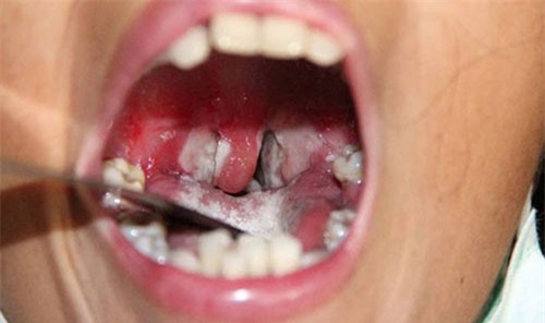 Bộ Y tế ra công điện khẩn đối phó dịch bạch hầu làm 3 người chết