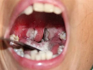 Bộ Y tế ra công điện khẩn đối phó dịch bạch hầu làm 3 người chết