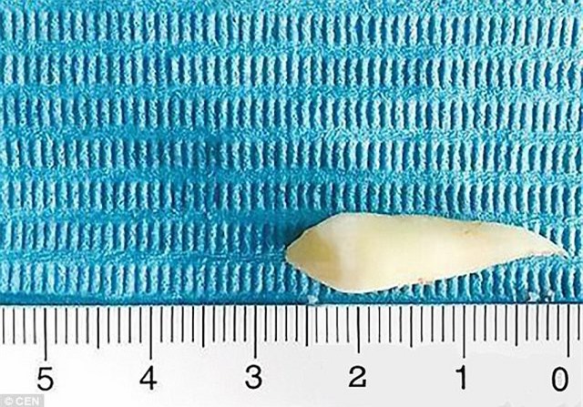 Trung Quốc: Hốt hoảng răng mọc gần... mắt