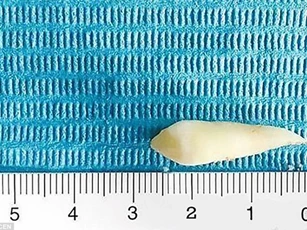 Trung Quốc: Hốt hoảng răng mọc gần... mắt