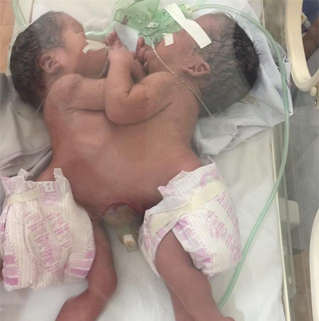 Xót xa cặp song sinh chung dây rốn, dính liền nhau