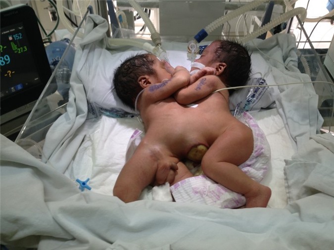 Tin mới nhất về sức khỏe cặp song sinh dính liền nhau ở Hà Giang